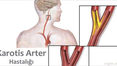 Karotis Arter Hastalığı