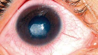 Kornea Ülseri (ülseratif keratit)