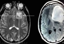 Astrositom (beyin tümörü)