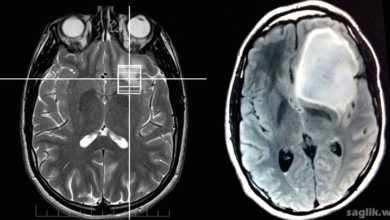 Astrositom (beyin tümörü)