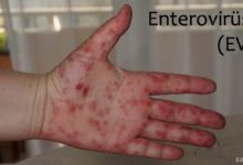 Enterovirüs 71 (EV71)