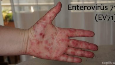 Enterovirüs 71 (EV71)