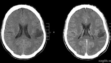 Gliom (beyin tümörü)