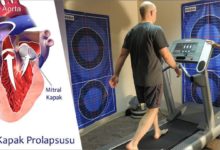 Mitral Kapak Prolapsusu