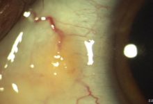 Pinguekula (göz beyazında sarı leke)