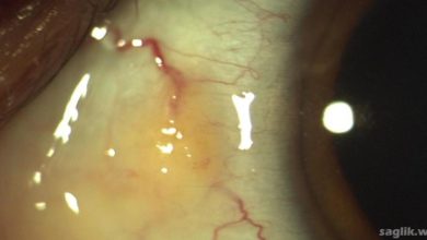 Pinguekula (göz beyazında sarı leke)