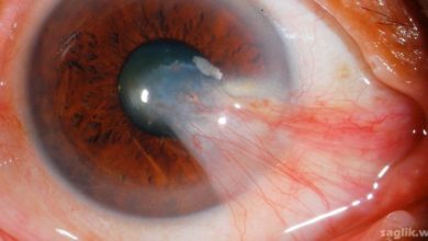 Pterjium (kuş kanadı)