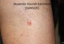 Skuamöz Hücreli Karsinom