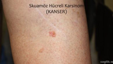 Skuamöz Hücreli Karsinom