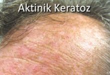 Aktinik Keratoz