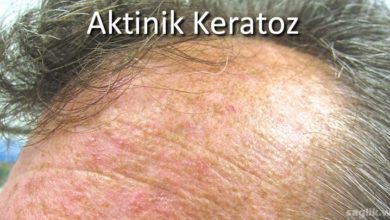 Aktinik Keratoz
