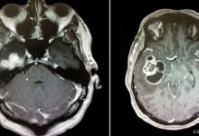 Glioblastoma Multiforme (GBM)