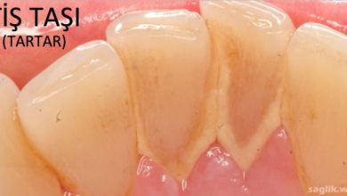 Diş Taşı (tartar)