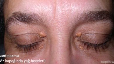 Ksantelazma (göz kapağında yağ bezeleri)