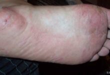 Dishidrotik Egzama (dishidroz)