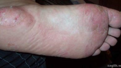 Dishidrotik Egzama (dishidroz)