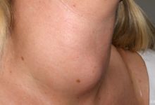 Hurthle Hücreli Tiroid Kanseri