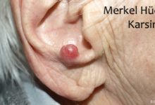 Merkel Hücreli Karsinom