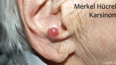 Merkel Hücreli Karsinom