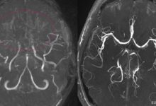 Moyamoya Hastalığı