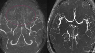Moyamoya Hastalığı