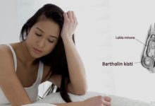 Bartholin Kisti