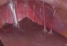 Fitz Hugh Curtis Sendromu