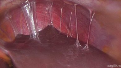 Fitz Hugh Curtis Sendromu