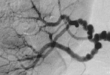 Fibromüsküler Displazi