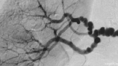 Fibromüsküler Displazi