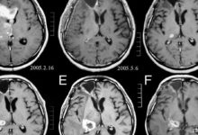 Anaplastik astrositom nedir?