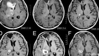 Anaplastik astrositom nedir?