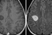 Diffüz Astrositom Nedir?