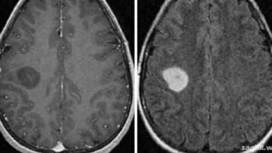 Diffüz Astrositom Nedir?