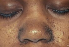 Tuberoskleroz Nedir?