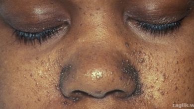 Tuberoskleroz Nedir?