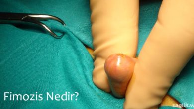 Fimozis Nedir?