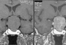 Hipofiz Adenomu Nedir?