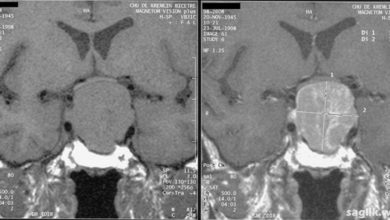 Hipofiz Adenomu Nedir?