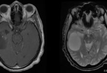 Oligodendrogliom Nedir?