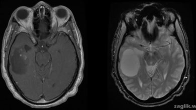 Oligodendrogliom Nedir?
