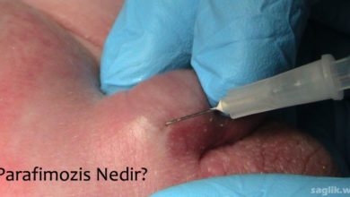 Parafimozis Nedir?