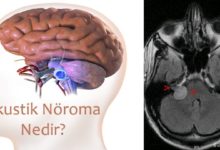 Akustik Nöroma (akustik nörinom)