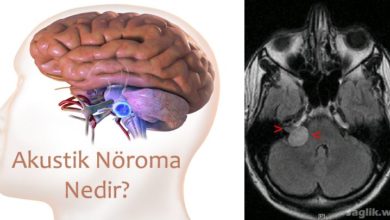 Akustik Nöroma (akustik nörinom)