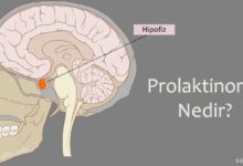 Prolaktinoma Nedir?