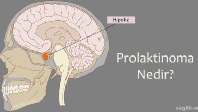 Prolaktinoma Nedir?