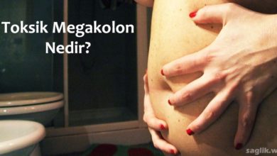 Toksik Megakolon