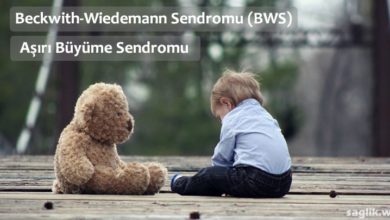 Beckwith Wiedemann Sendromu Nedir?