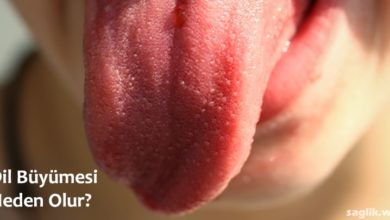 Dil Büyümesi (makroglossia)