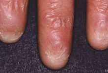 Diskeratozis Konjenita